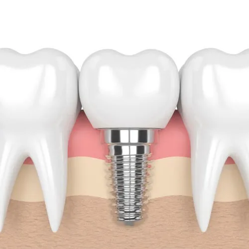 Dental Implants