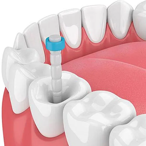 Single-Sitting Root Canal